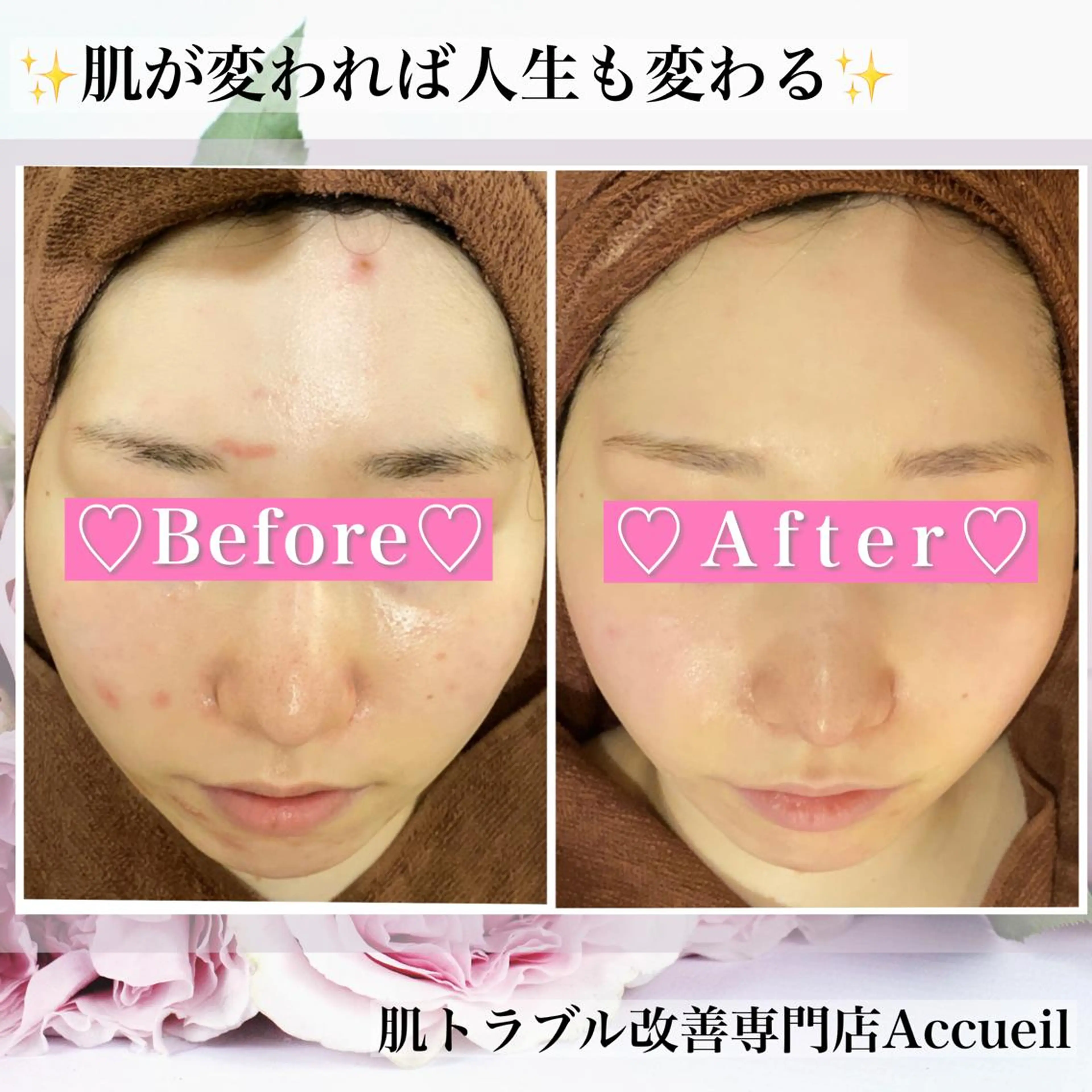 ミディアム カラー パーマ ヘアアレンジ メンズ キッズ ネイル マツエク・マツパ アイブロウ エステ リラク アクール　齋藤 ♡肌トラブル卒業のエステ・リラクイメージ