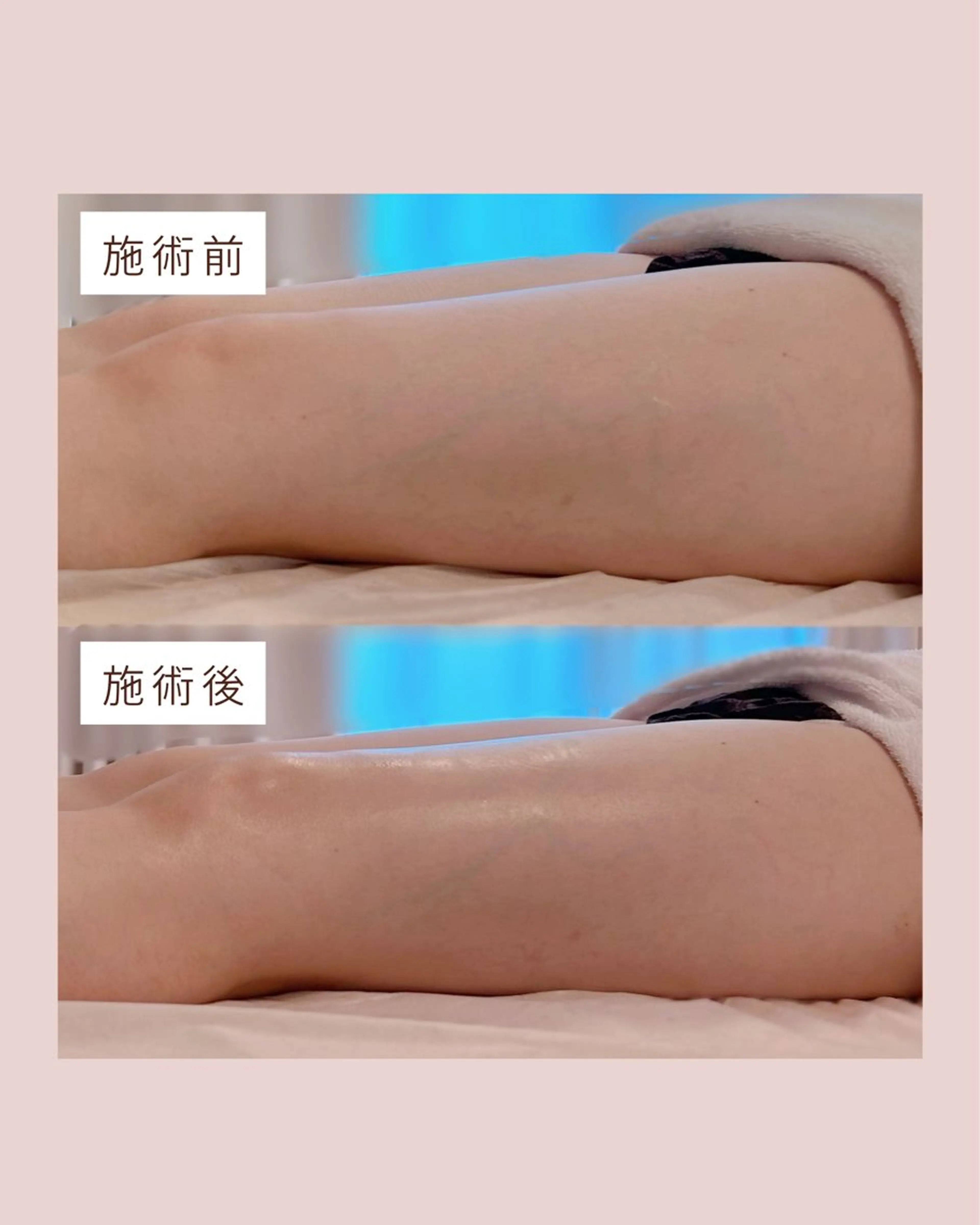 肩こりやむくみにお悩みの方へ✨インディバボディ90分✨の写真
