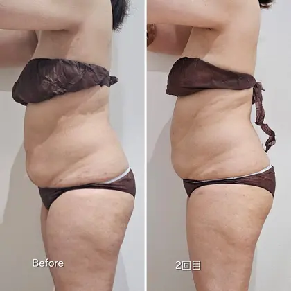 脂肪冷却の吸引カップ アタッチメント No.2 脂肪冷却の吸引カップ