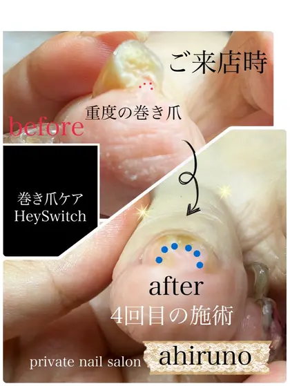 ネイルデザイン・アートカタログ「巻き爪ケア【HeySwitch】 4回目の