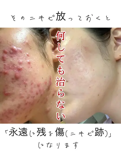 美ラボ様限定剥離ありハーブピーリング50回分 美ラボ様限定剥離ありハーブピーリング50回分