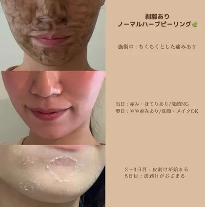 剥離ありハーブピーリングの流れです ノーマルハーブピーリングは