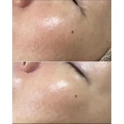 ハーブピーリングのお客様です。 国産ハーブピーリングなので安心