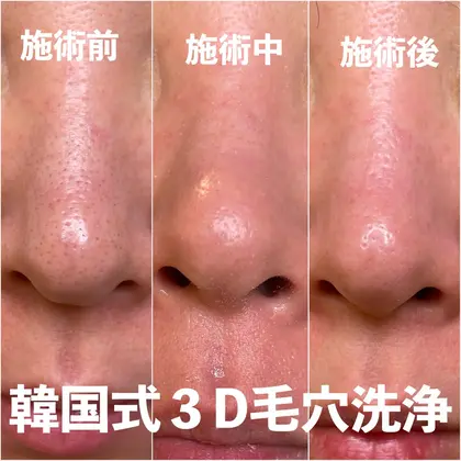 韓国式3D毛穴洗浄 #結果のでる毛穴洗浄 #浮き出る｜New所属・New