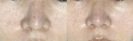 【人気No.1フェイシャル】メンズOK⭐︎話題毛穴洗浄×美白ペプチド美容液超音波導入×デコルテマッサージ