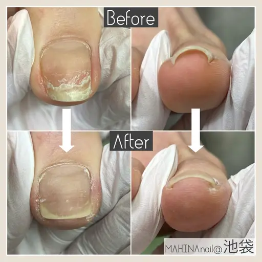 痛い巻き爪にも❗️両親指の巻き爪が気になる方👉🏼巻き爪ケア両親指¥15400