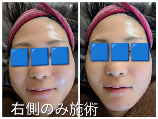 フェイシャルエステ