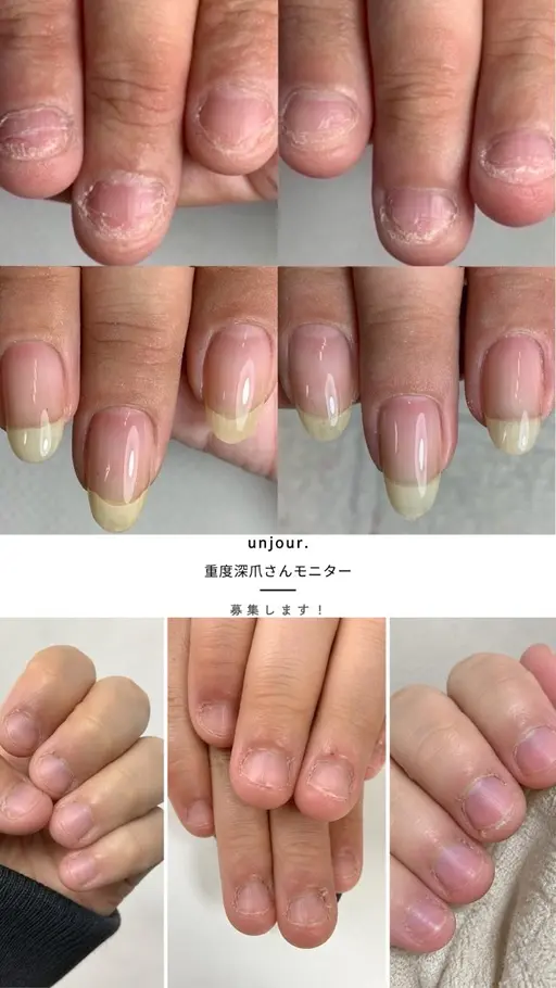 【重度深爪】自爪育成モニター