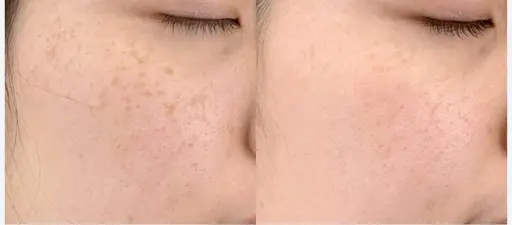 【シミ】シミ、そばかすケア✨