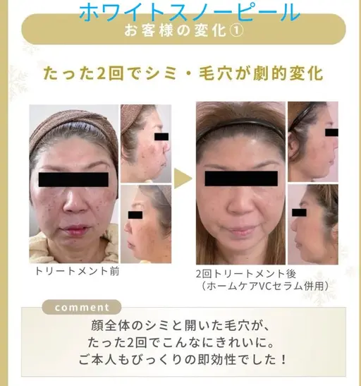 エリア初導入【透明感・ツヤ特化】ホワイトスノーピール・水光コース