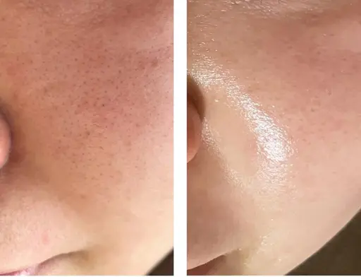 本気の肌管理✨\IPL光フェイシャル+艶肌ピーリング+お顔脱毛+毛穴洗浄+幹細胞パック/