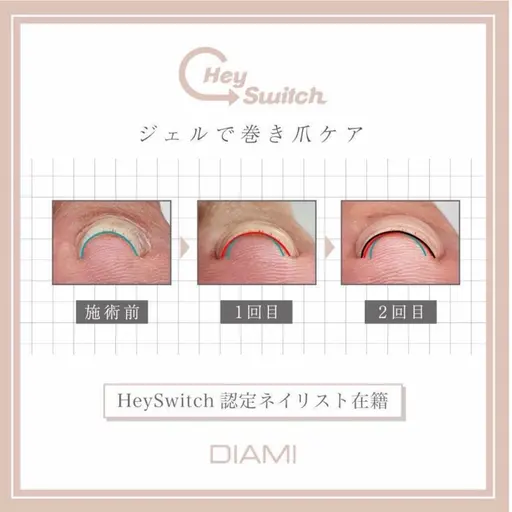 【巻き爪・食い込み改善】 特殊ジェル巻き爪ケア🌈