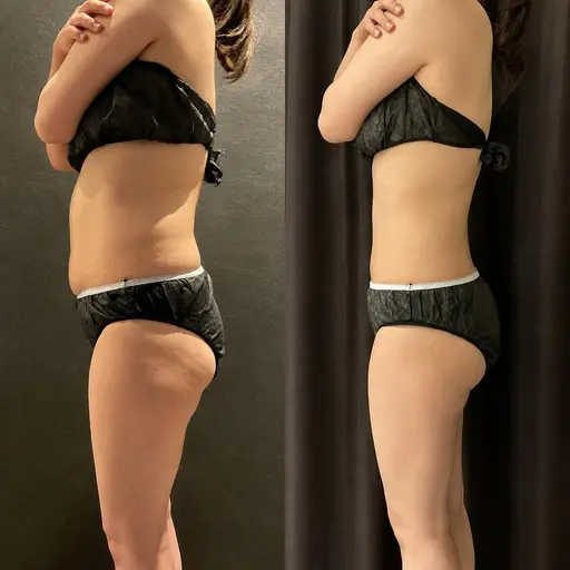 冷却ダイエット【筋膜リリース、引き締め美容液付き❗️】痩身❄️痩せたい部位の脂肪を集中アプローチ！2部位（4カップ）