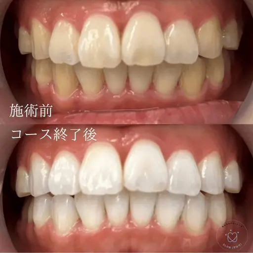 ※初回はジェルの注文のみです!【持続期間・白さにこだわるなら】歯科提携ジェルホワイトニング 美容ホワイトニングは当日可能