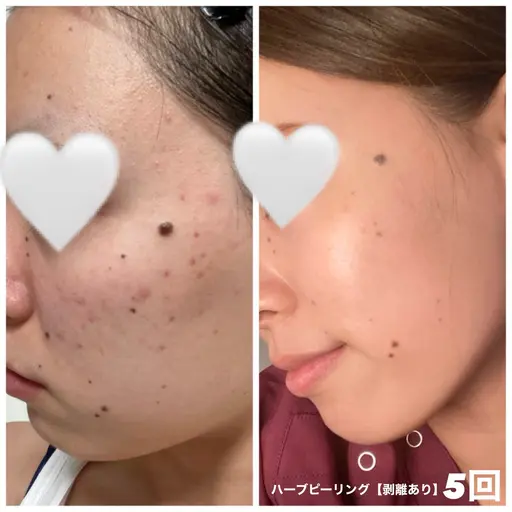 《人気No.3》内側と外側にWアプローチで素肌美人🤍🫧【ハーブピーリング＋電気美容鍼 120分】
