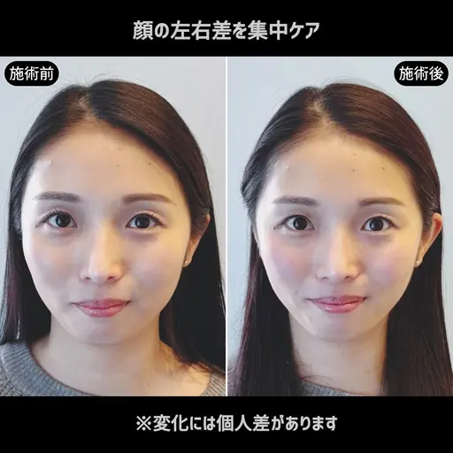 【顔の左右差を集中ケア】顔バランス整体×EMS美容鍼 70分