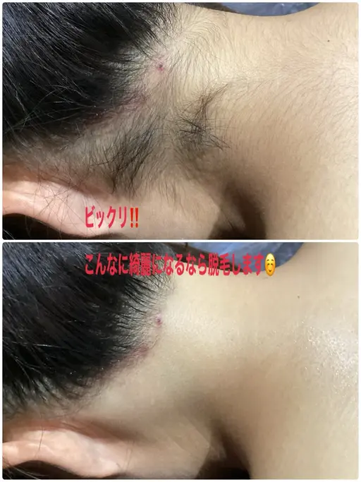 【全身+VIO脱毛】1番人気🥇2900人が利用!全箇所自己処理不要💁🏻♀️剃らずに来店ok👌1回¥9000