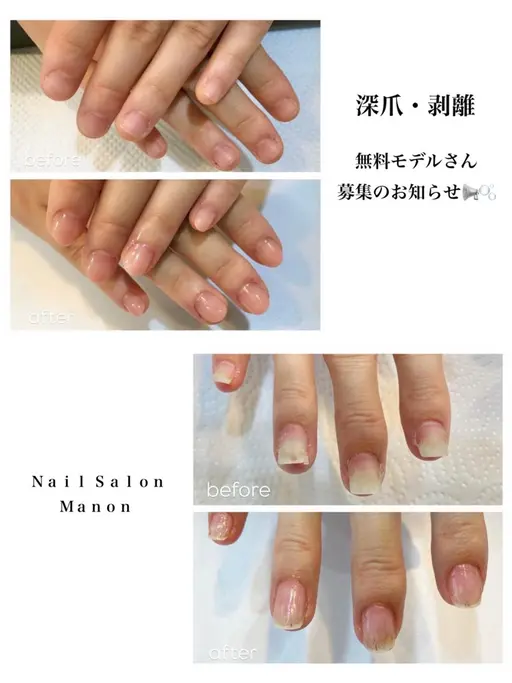 【無料】🌿10/7(水) 13:00〜【深爪・剥離】無料モデル募集📢✨