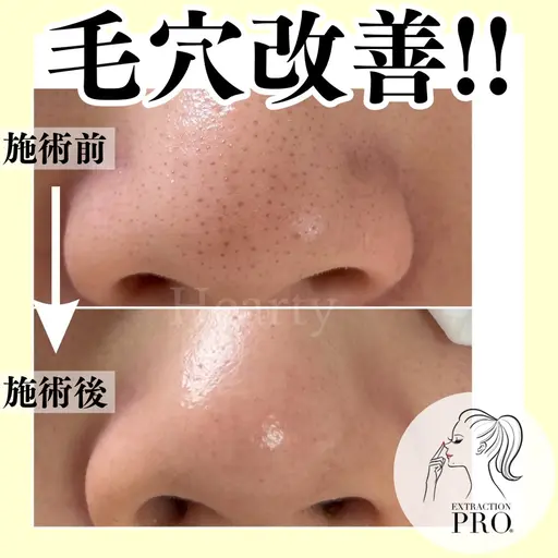❤️minimo価格\\即実感//結果重視!!毛穴エクストラクションプロ/フェイシャルエステ💆🏻♀️