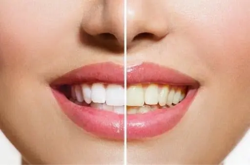 セルフホワイトニング30分【スタンダードコース】