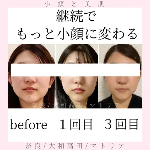 ご新規様限定✨️お得！最短で小顔効果を実感の３回継続、小顔矯正リフトフェイシャルコース