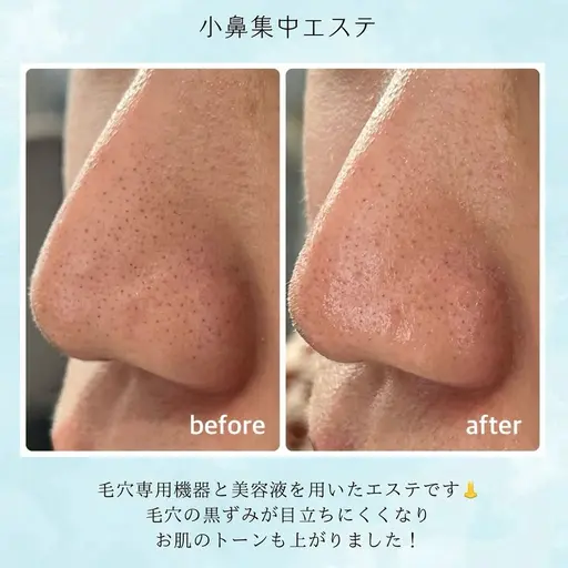 毛穴のざらつきすっきり👃✨小鼻集中エステ+超音波エステ