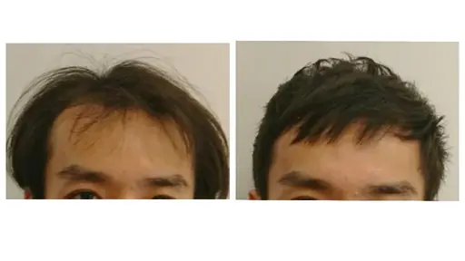 男性限定、薄毛ケアのショートカットモデル