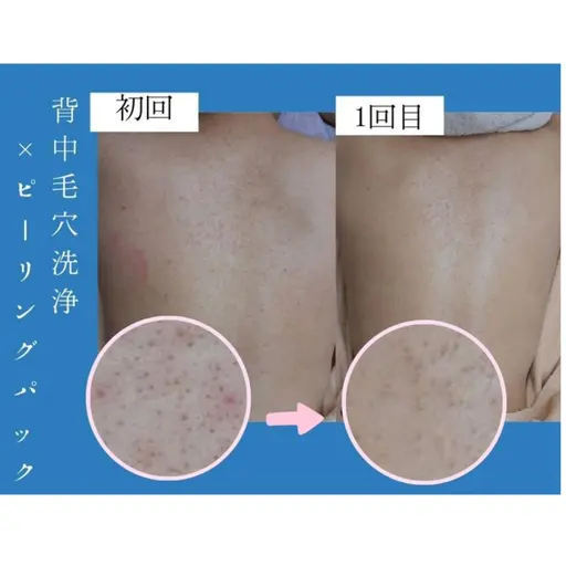 【背中ニキビ&シミ】背中ケアキャンペーン!肌みせ前にお肌ケア♪背中毛穴洗浄+肌別パック※クーポン内容要確認
