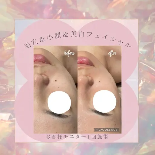 3日来店限定❣️ぷるもち肌フェイシャル【毛穴×小顔×ツヤ】毛穴の広がり・黒ずみが気になる方へ✨1980円