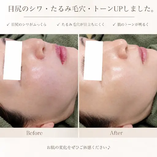 たるみ毛穴改善ハーブピーリング♪￥15,000円→￥11,800円ミニモ限定