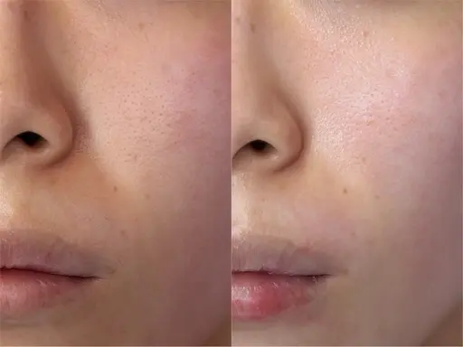 フェイスワックス脱毛🧡