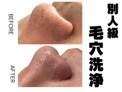【9/7限定】毛穴洗浄＋ドライヘッドスパ　毛穴の詰まり/黒ずみ毛穴/ごわつき/くすみ　¥3300