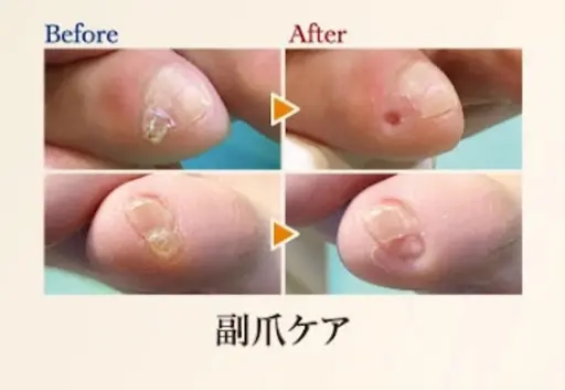【副爪ケア】小指の爪横にある爪みたいなもの🔅綺麗に除去します✨