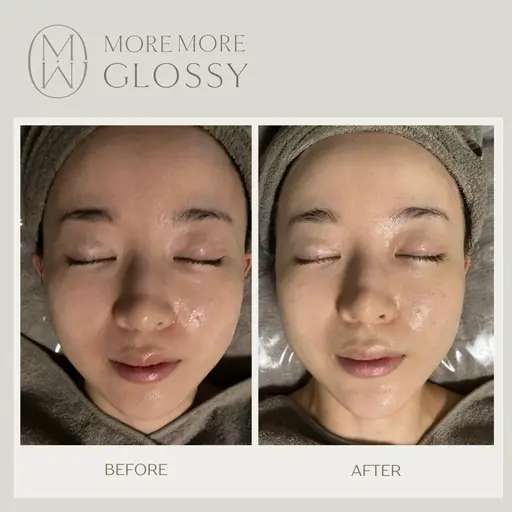 人気No.1💎眠れる美女コルギ50分/お悩み別に特化した施術で理想のフェイスラインに◎💆