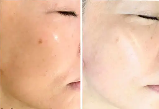 【モヤモヤしたシミにはこれ‼️】15分当て放題／特別3回モニター通常49,500円→32,500円