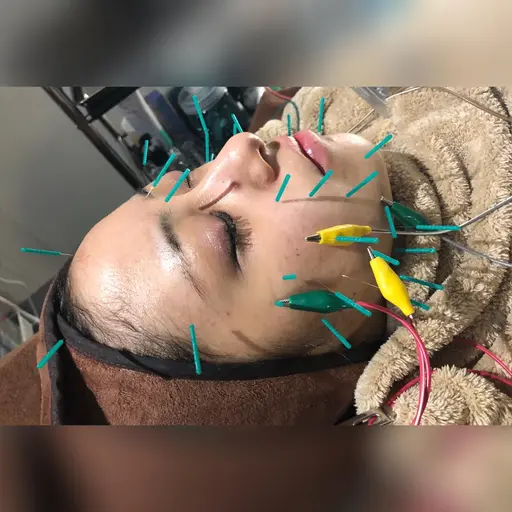 人気②💖電気の美容鍼90分✨施術後別人😵超音波｡ラジオ波｡かっさ｡整顔｡幹細胞/2回目からもお得！