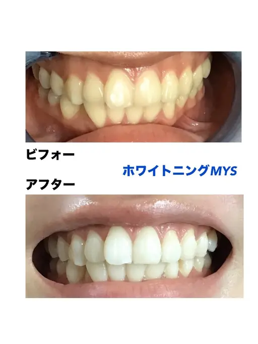 【初めての方限定✨】即実感!話題のセルフホワイトニング15分×2回照射を1,650円で!