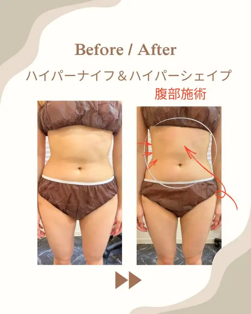 【ぽっこりお腹をすっきりさせたい方に】ハイパーナイフ20分+ハイパーシェイプ10分