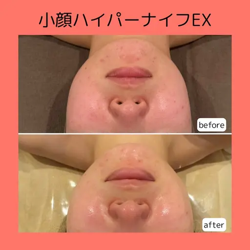【ミニモ学割👧🏻U24】シャープなフェイスラインで垢抜け印象へ❣️透明感小顔フェイシャル💎✨(ハイパーナイフEX)