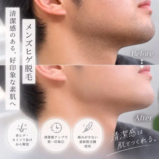 メンズ ひげ脱毛(全体)
