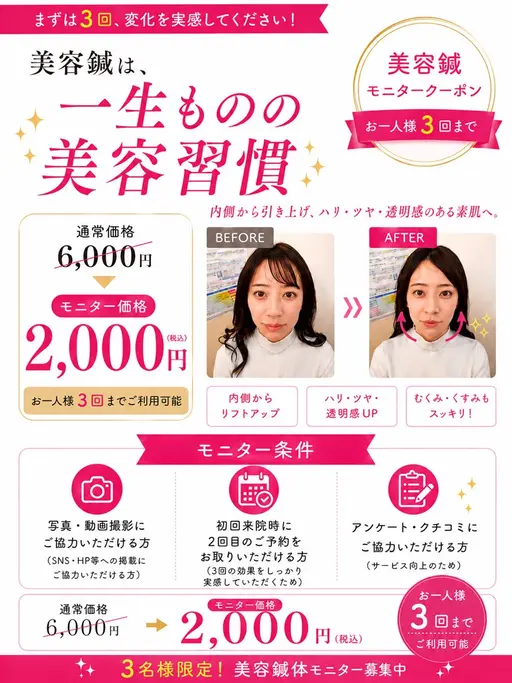 ✨️💃美容鍼モニター募集💃✨️通常6,000円 → モニター価格2,000円【3回まで利用可能】