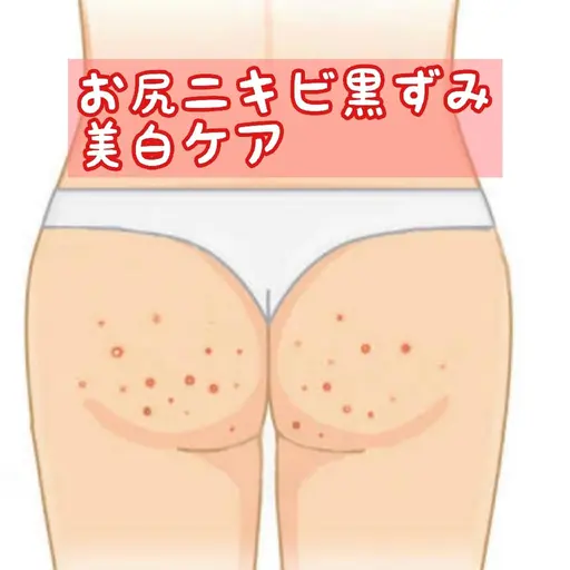 仮予約お得🉐🌷🌈お尻ニキビ黒ずみ😍🌸を美白ケア&ハーブピーリング