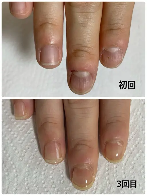 【縦長美爪へ】40代からの健康的な自爪育成(長持ちフィルイン＆パラジェル)※初回ホームケア用品2100円分込