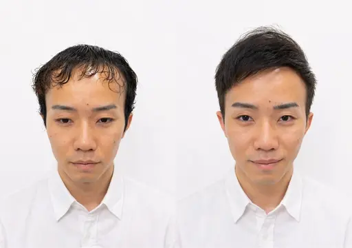 顔出し有りモデル募集【薄毛に悩む男性専門】カット