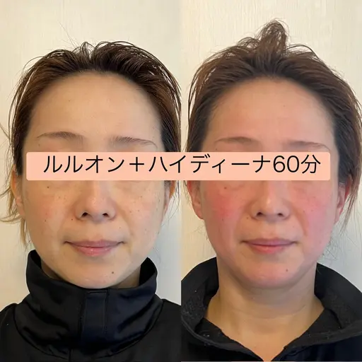 【2回目限定】人気急上昇！全身水素まみれコース¥10800