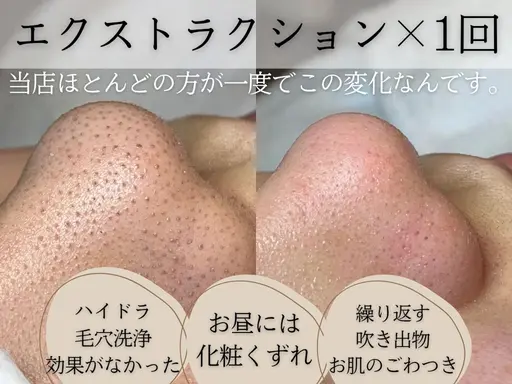 【一撃イチゴ鼻】毛穴エクストラクション鼻のみ