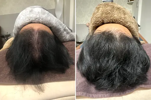 人気①メンズ育毛鍼真剣にお悩みは是非安心プライベートサロン💖18700→今だけ