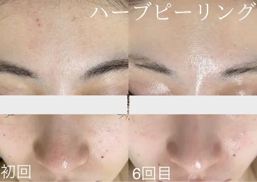 【夏限定】毛穴・皮脂すっきりハーブピーリング !