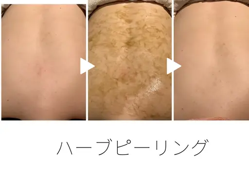 ブライダルにオススメ🍀ハーブピーリング🍀背中、二の腕のブツブツ肌質改善/背中全体&二の腕トリートメント
