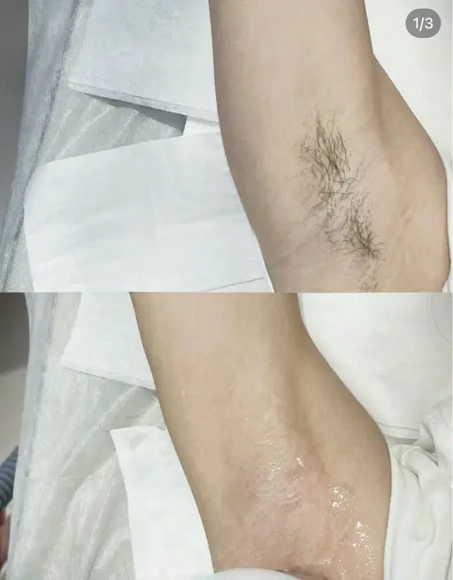両脇脱毛